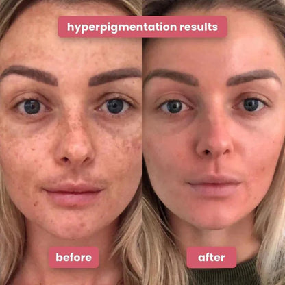 Exfoliating Turmeric Kojic acid pads - Reveal Your Radiant Skin